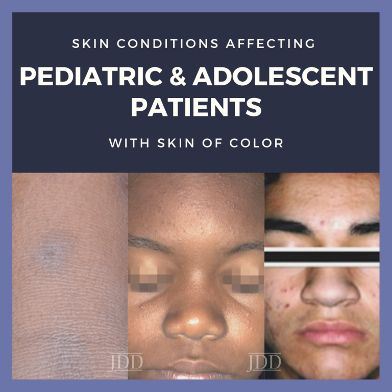 Skin Conditions in Pediatric & Adolescent Patients with Skin of Color