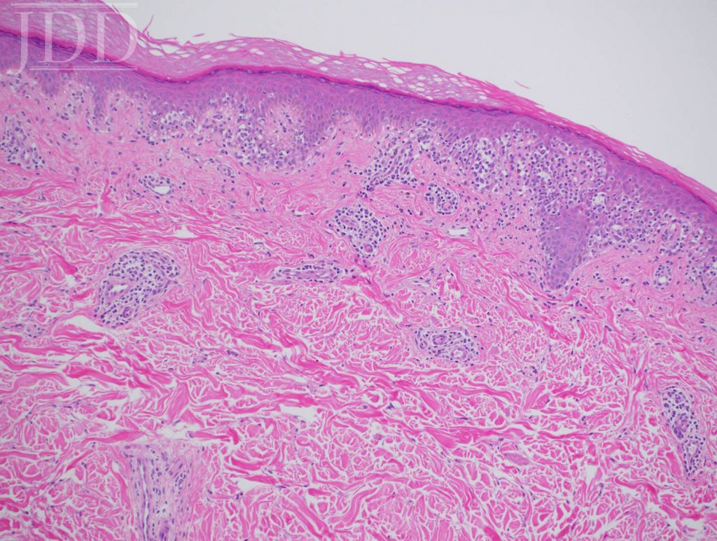 mycosis fungoides histology