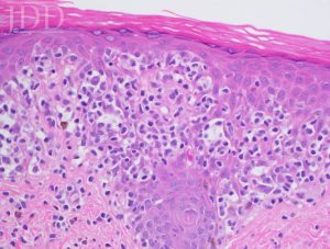 Hypopigmented Mycosis Fungoides: A Clinical Mimicker of Vitiligo - Next ...