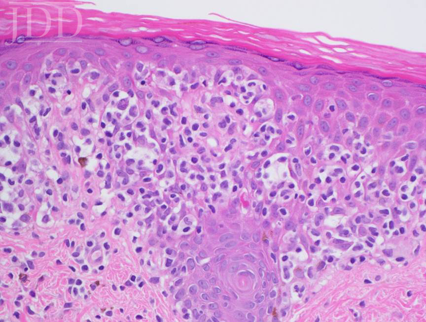 Hypopigmented Mycosis Fungoides (HMF)