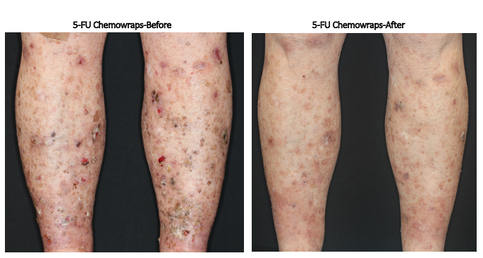 Chemowraps for actinic keratoses (AKs)