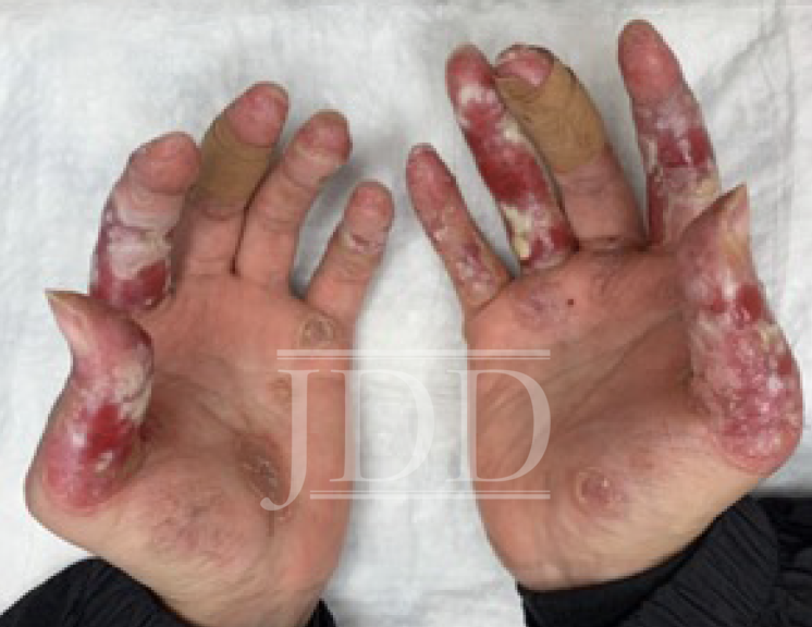 lupus pernio hands