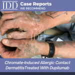 Chromate-Induced Allergic Contact Dermatitis Treated With Dupilumab