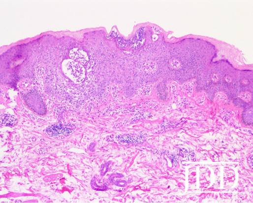 Chromate-Induced Allergic Contact Dermatitis Treated With Dupilumab