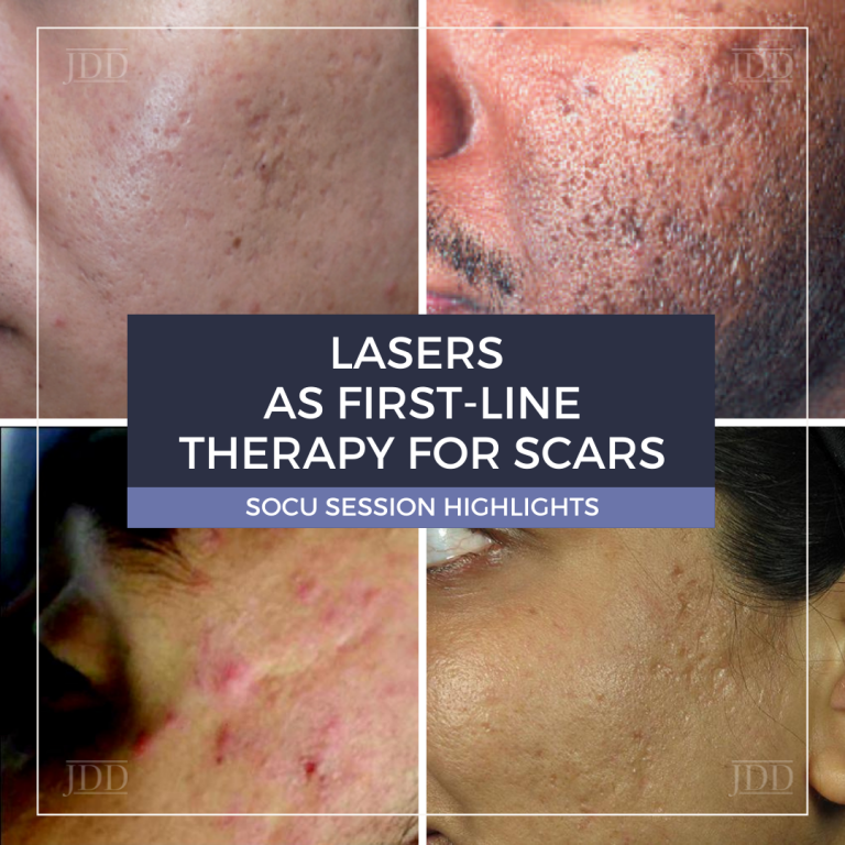 Lasers as FirstLine Therapy for Scars Next Steps in Dermatology