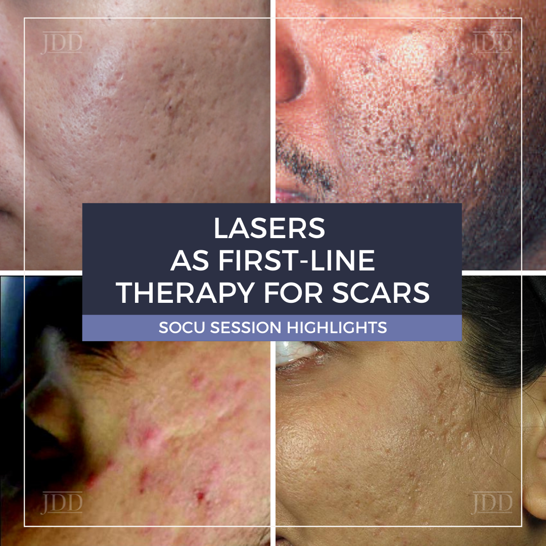 Lasers for scars