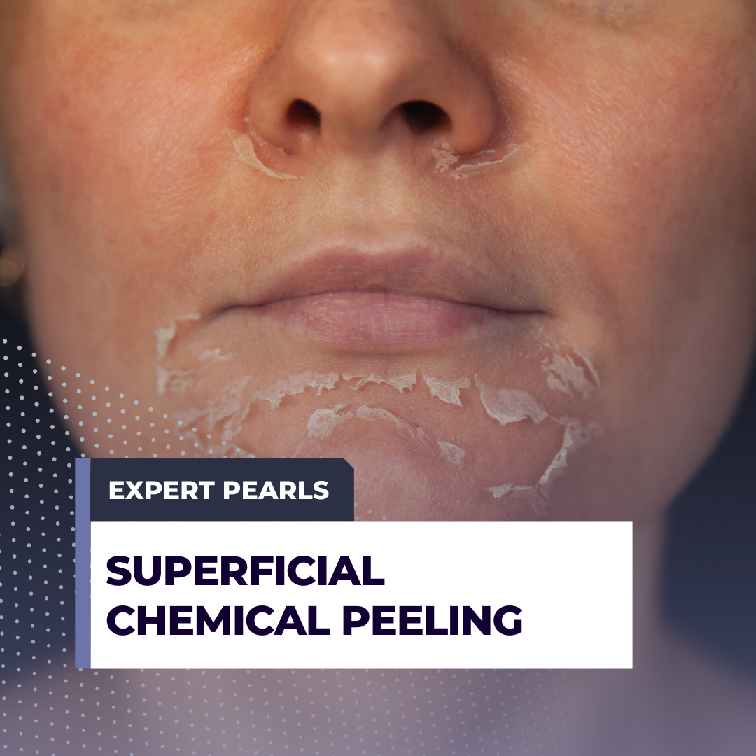 Chemical Peel: Types, Uses, Recovery