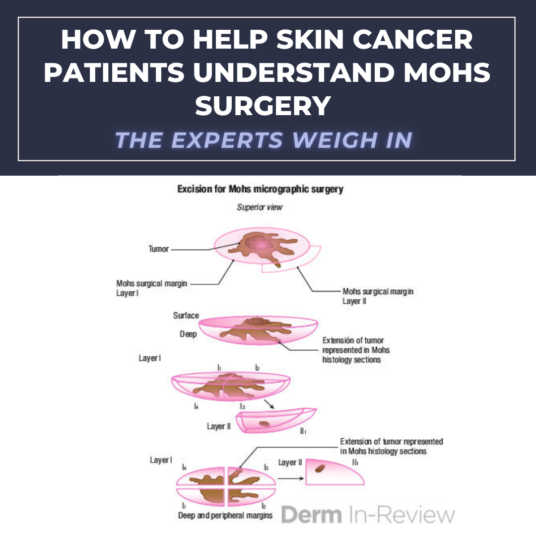 How To Help Skin Cancer Patients Understand Mohs Surgery The Experts Weigh In Next Steps In