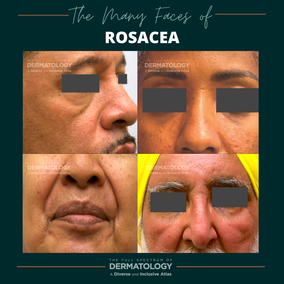 the many faces of rosacea