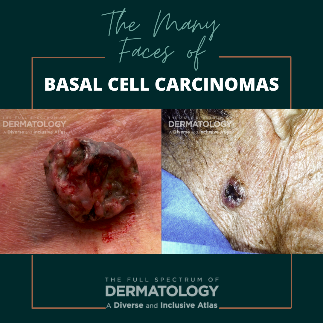 Basal Cell Carcinomas