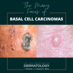 The Many Faces of Basal Cell Carcinomas (BCCs) - Next Steps in Dermatology