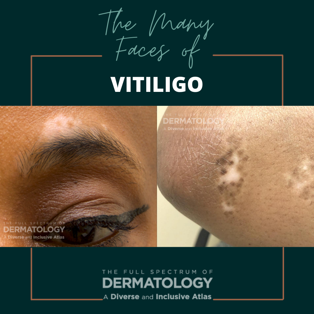 The Many Faces of Vitiligo - Next Steps in Dermatology