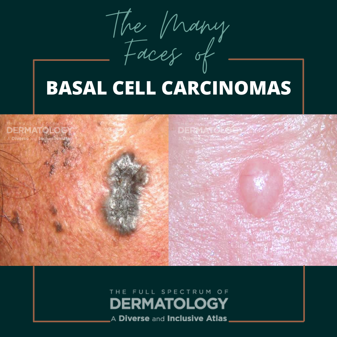 Basal Cell Carcinomas