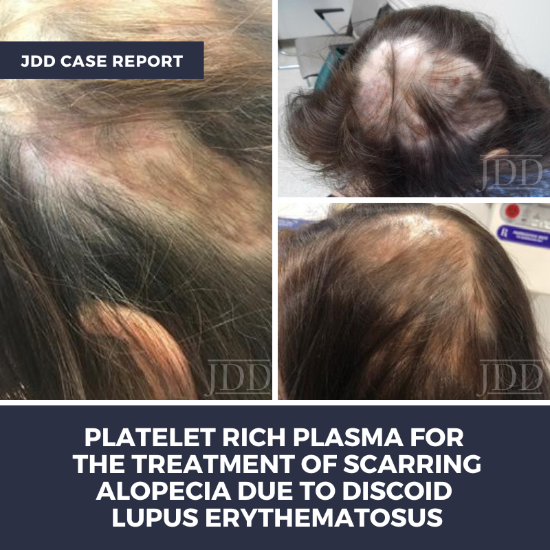 PRP for Scarring Alopecia Due to Discoid Lupus Erythematosus (DLE) - Next  Steps in Dermatology