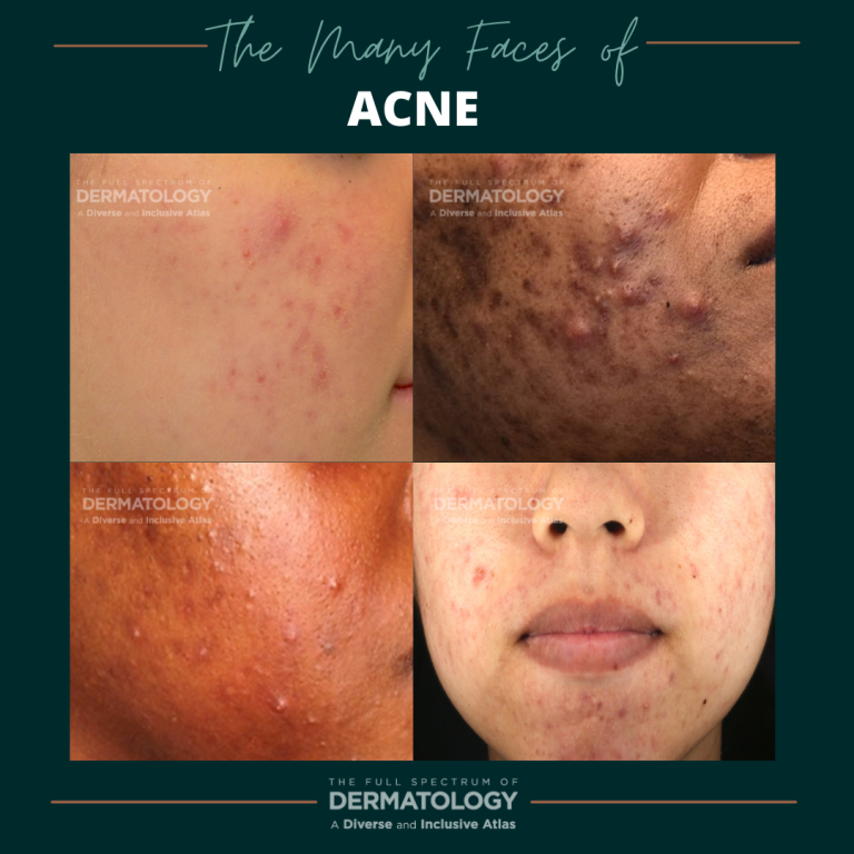 The Many Faces of Acne Next Steps in Dermatology