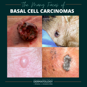 The Many Faces of Basal Cell Carcinomas (BCCs) - Next Steps in Dermatology