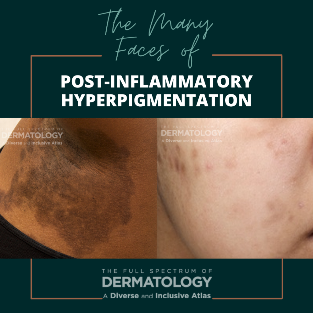 The Many Faces Of Post Inflammatory Hyperpigmentation Pih Next