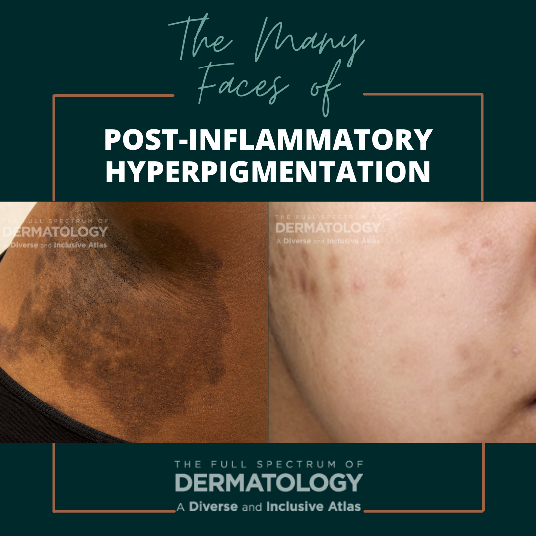post-inflammatory hyperpigmentation