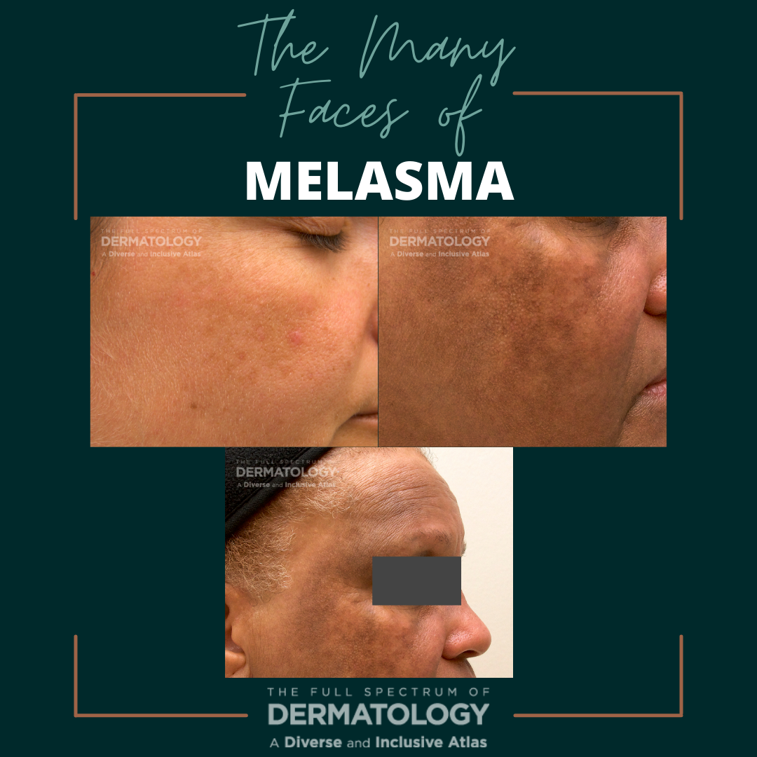 melasma