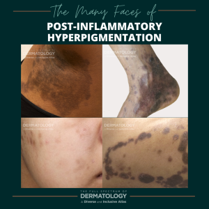 The Many Faces Of Post-Inflammatory Hyperpigmentation (PIH) - Next ...