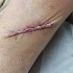 It's Mnemonic Monday! | Stages of Wound Healing - Next Steps in Dermatology