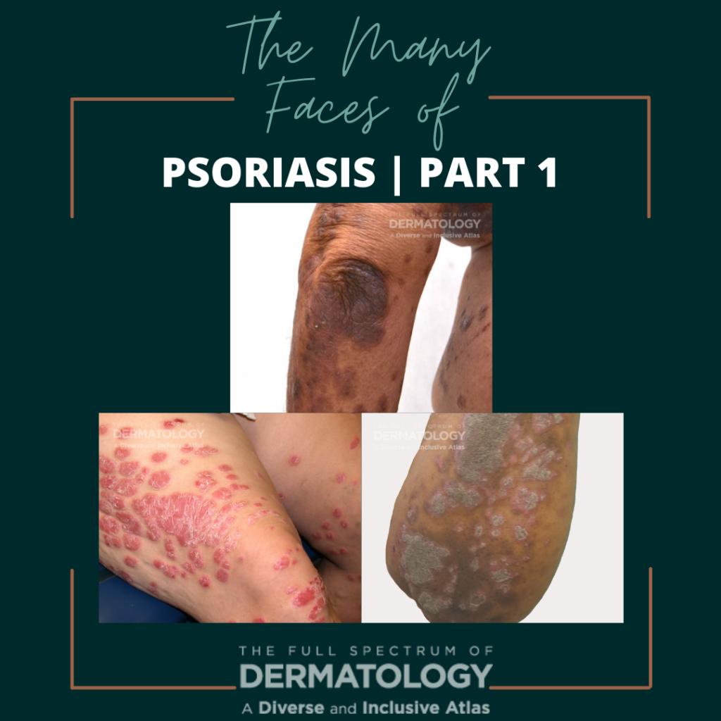 The Many Faces of Psoriasis | Part 1 - Next Steps in Dermatology