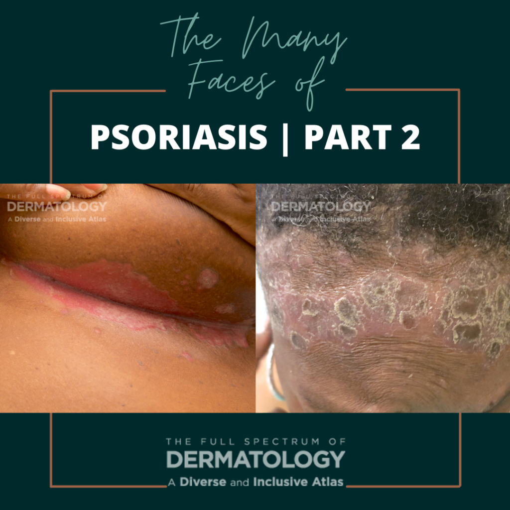 The Many Faces of Psoriasis | Part 2 - Next Steps in Dermatology