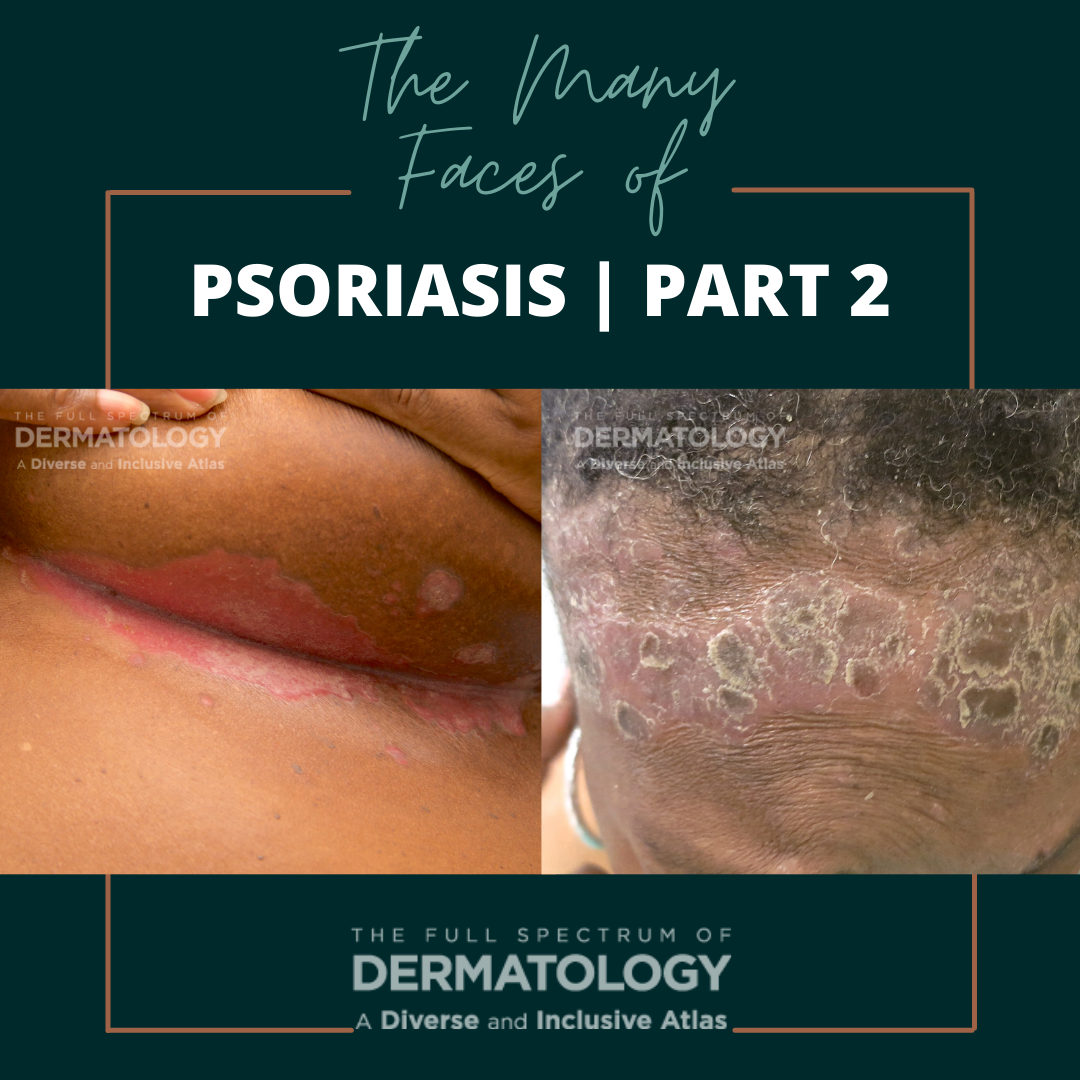 The Many Faces of Psoriasis | Part 2 - JDDonline - Journal of Drugs in ...