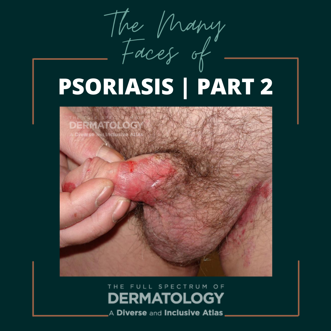 psoriasis