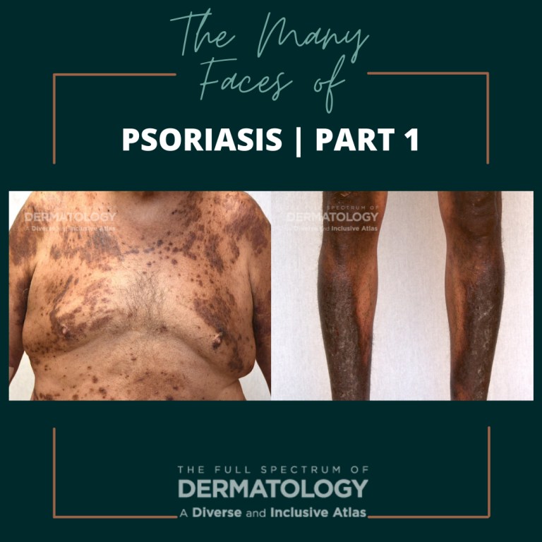 The Many Faces of Psoriasis | Part 1 - Next Steps in Dermatology