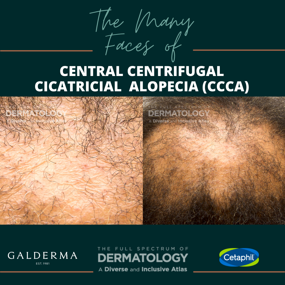Central Centrifugal Cicatricial Alopecia (CCCA)