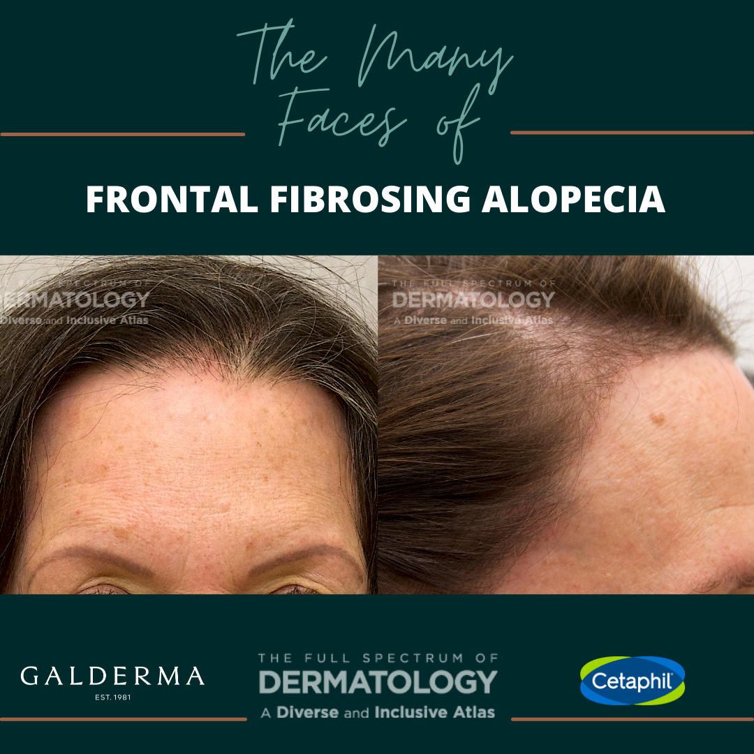 The Many Faces of Frontal Fibrosing Alopecia (FFA) - Next Steps in ...