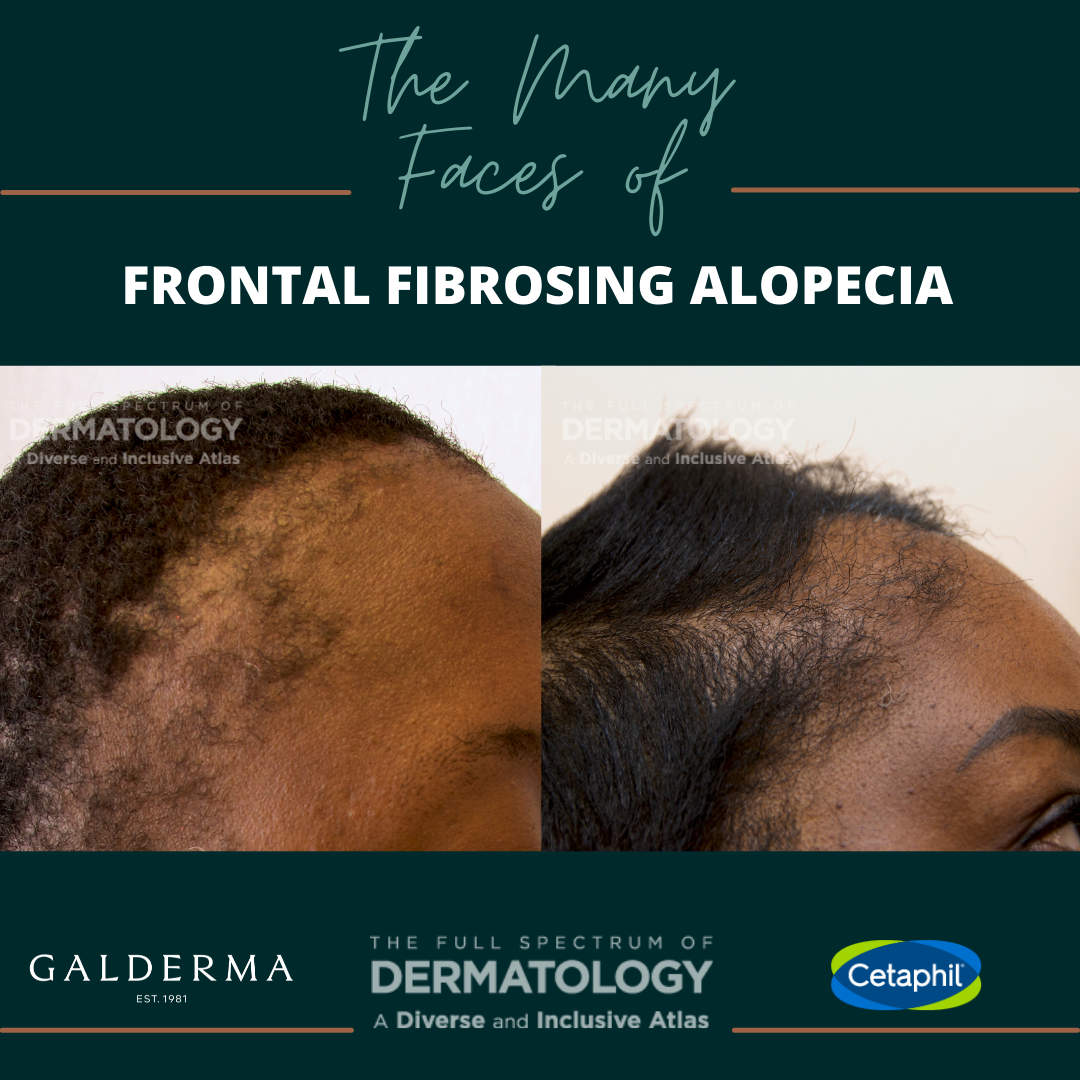 Causes and Treatment of Frontal Fibrosing Alopecia FFA