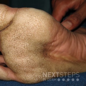 FOOT RASPING DAY! The other foot -- with EPPK Keratoderma Hyperkeratosis -  Jun 7, 2023 