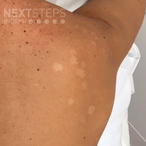 Medical: Tinea versicolor is a condition caused by the Malassezia globosa  fungus a form of yeasts. It is characterized by a skin discolor eruption on  the trunk and proximal extremities. Stock Photo