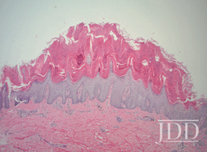 Verrucous Psoriasis