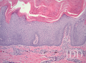 Verrucous PsoriasisVerrucous Psoriasis