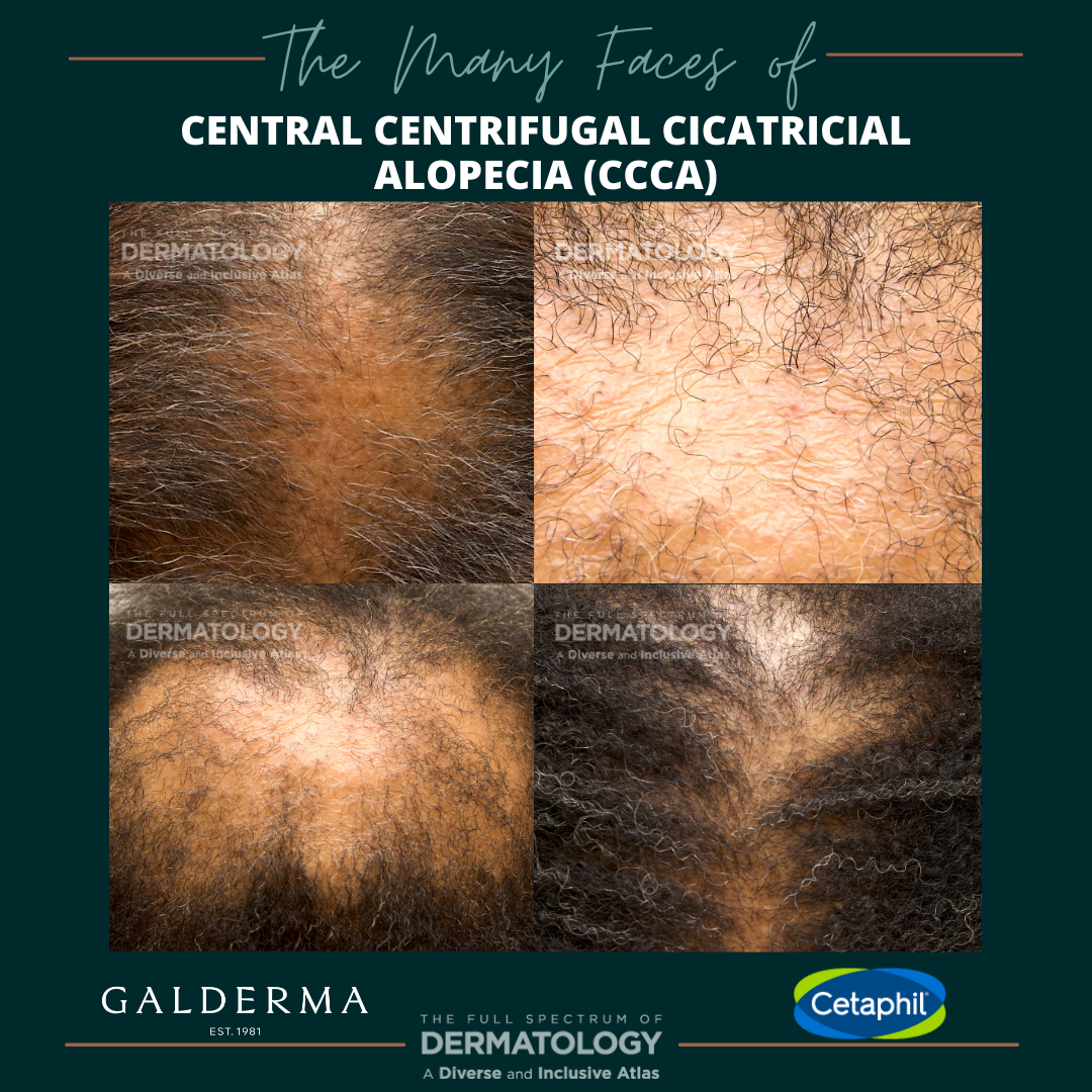 Central Centrifugal Cicatricial Alopecia (CCCA)