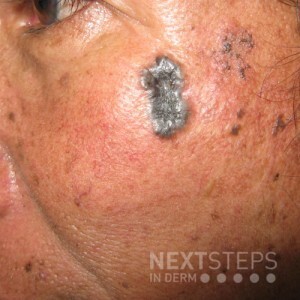 Tinea versicolor - Friday Pop Quiz 9/2/2022 - Next Steps in Dermatology