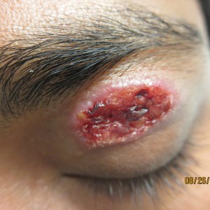 cutaneous leishmaniasis