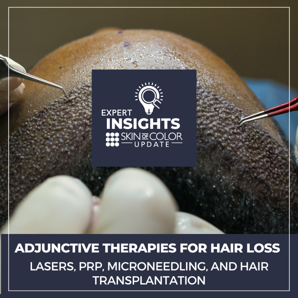 Adjunctive Therapies for Hair Loss Lasers, PRP, Microneedling, and Hair Transplantation Next