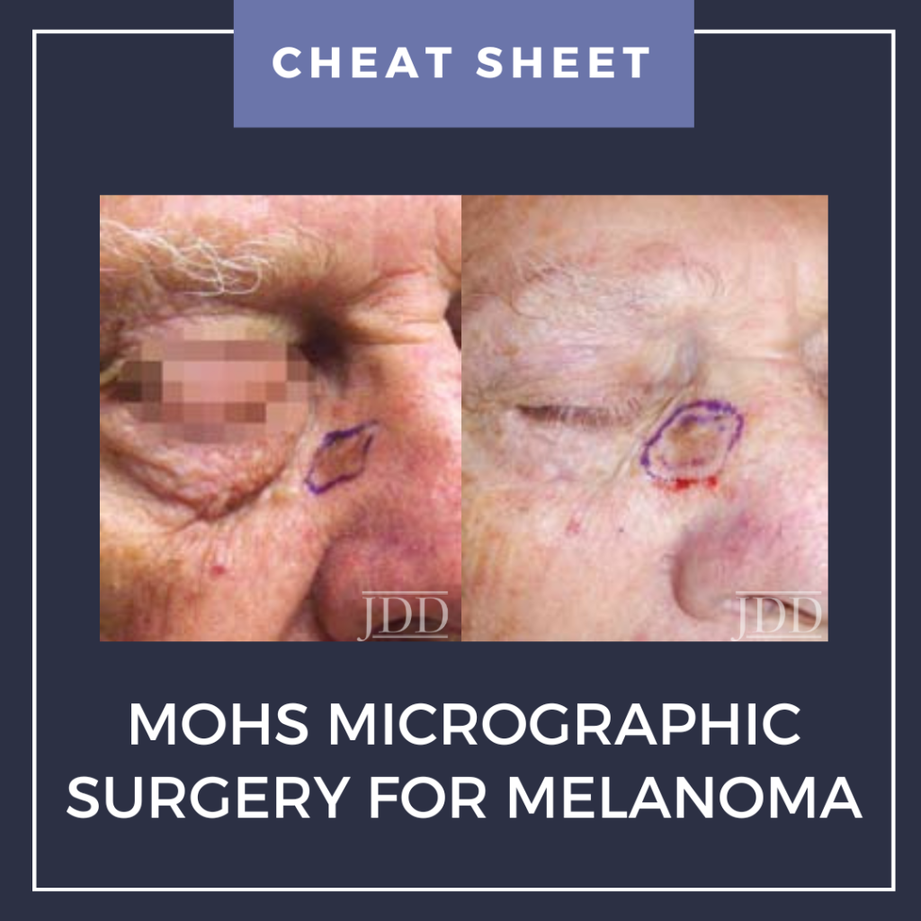 Mohs Micrographic Surgery For Melanoma MMS M Cheat Sheet Next 