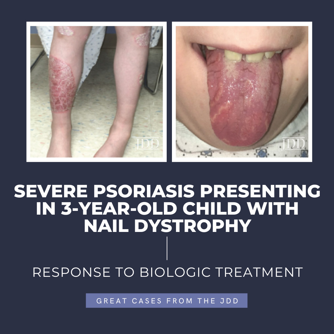 psoriasis