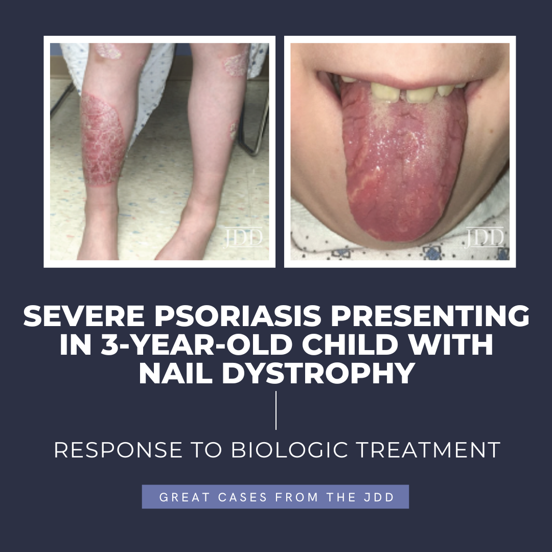 Severe Psoriasis Presenting In 3 Year Old Child With Nail Dystrophy 