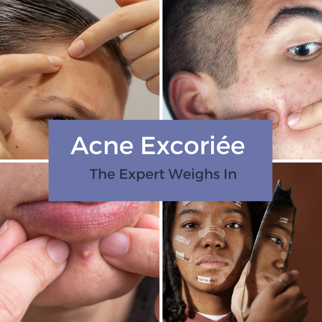 Patient Buzz Acne Excori e The Expert Weighs In Next Steps In 