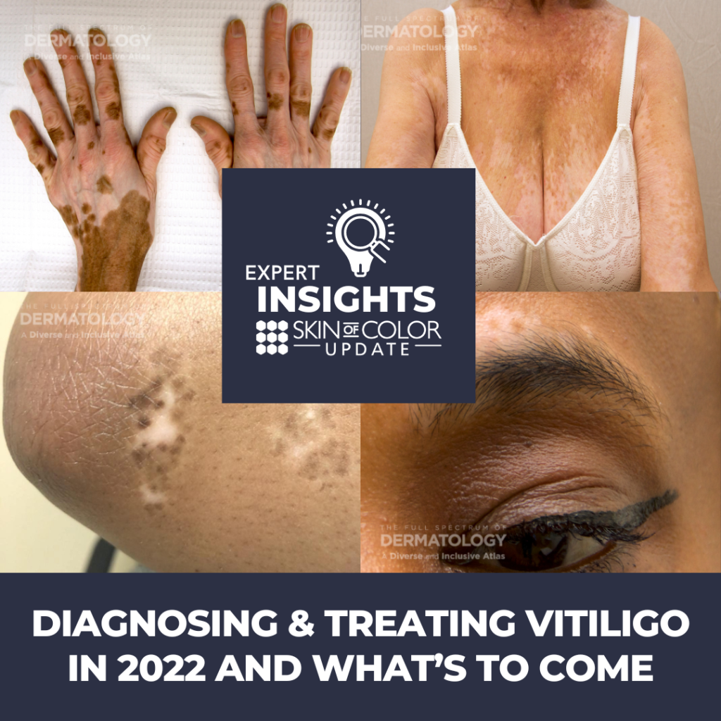 vitiligo new research 2022