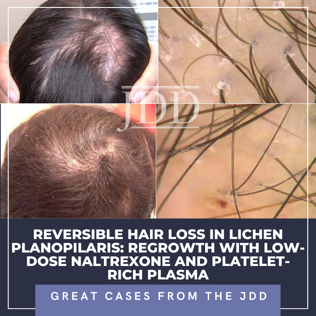 Reversible Hair Loss in Lichen Planopilaris | Great Cases from the JDD -  Next Steps in Dermatology