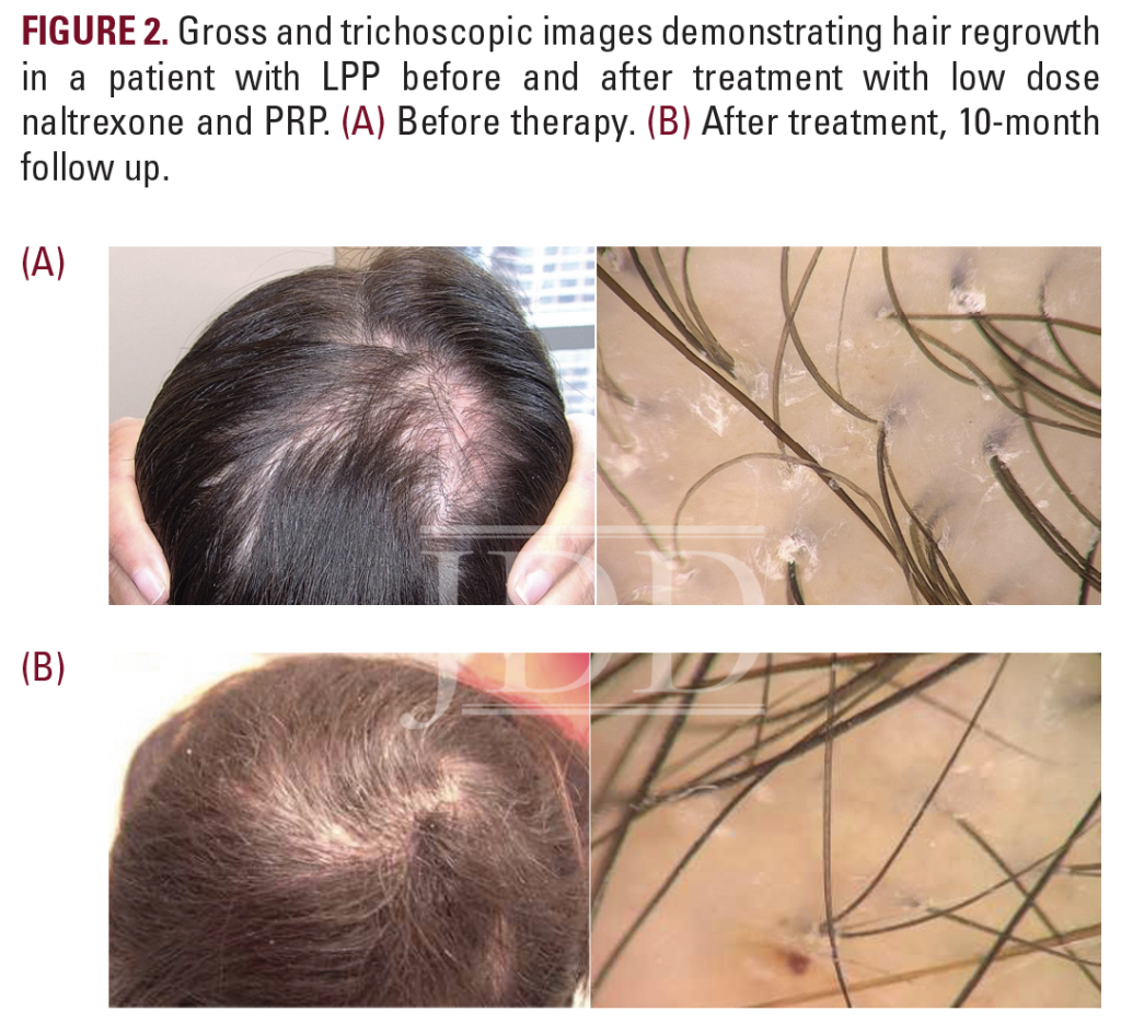 Reversible Hair Loss in Lichen Planopilaris Great Cases from the JDD