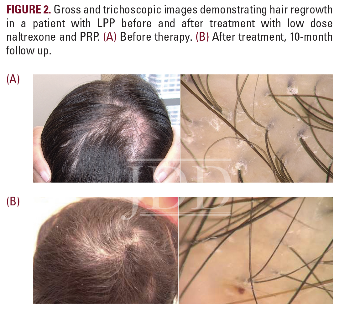 Reversible Hair Loss in Lichen Planopilaris | Great Cases from the JDD -  Next Steps in Dermatology