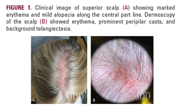 clobetasol propionate for hair loss